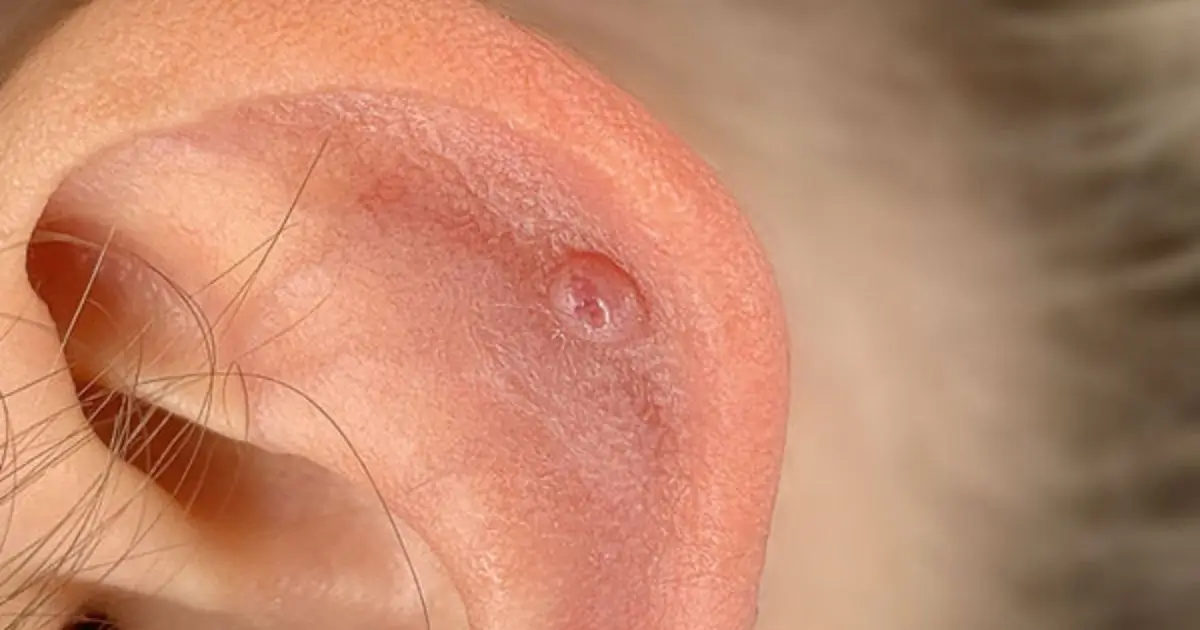 Granuloma piercing