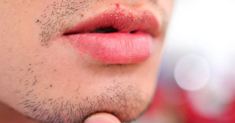 Grânulos de Fordyce